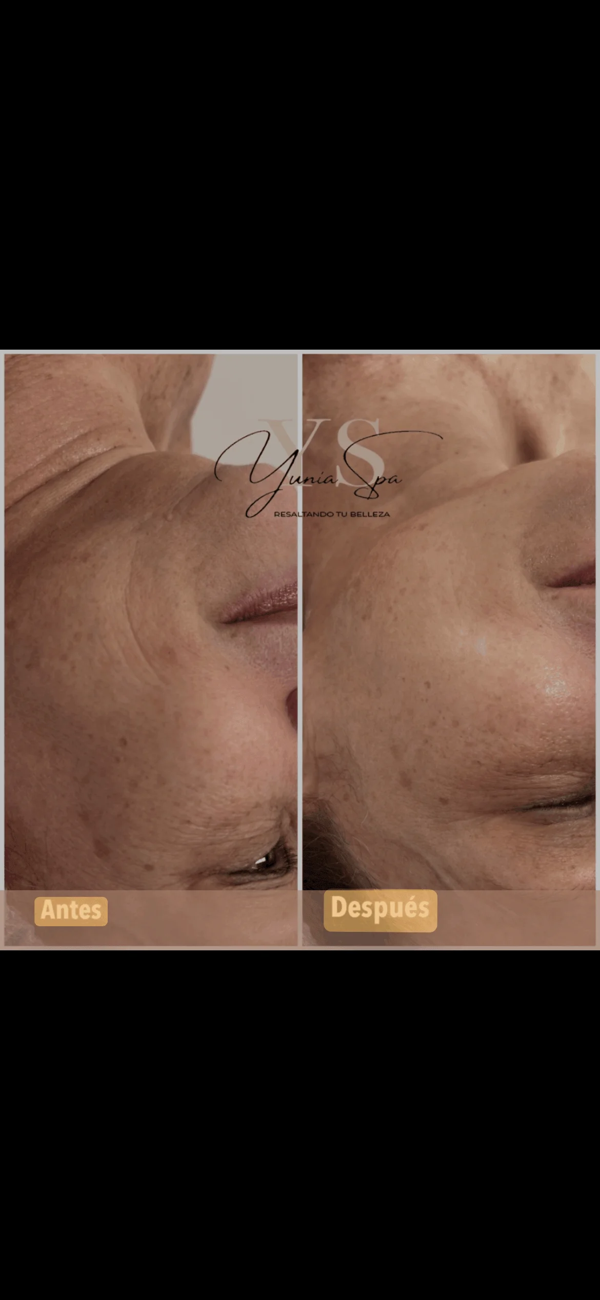 Before and after facial rejuvenation treatment
