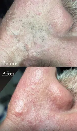 Before and after nose treatment